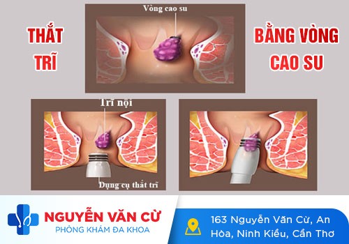 Thắt Búi Trĩ Ở Đâu Giỏi, Chi Phí Bình Dân