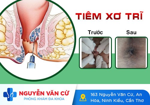 Địa Chỉ Làm Teo Búi Trĩ Tốt, Không Cảm Giác, Giảm Triệu Chứng Chỉ Sau 1 Liệu Trình