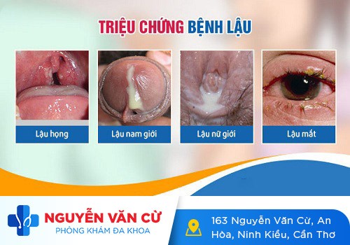 Biểu hiện bệnh lậu – đa số đều không biết đến thông tin này