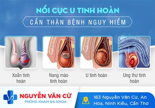 Nổi Hạch Ở Tinh Hoàn: Nguyên Nhân, Dấu Hiệu Và Cách Chữa