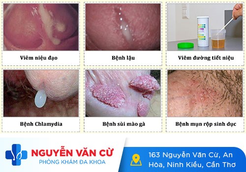 Kiểm Tra Và Điều Trị Dương Vật Chảy Mủ