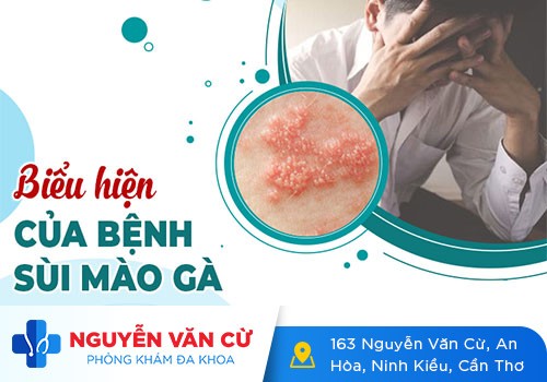 Cách Nhận Biết Bệnh Sùi Mào Gà Ở Nam Giới