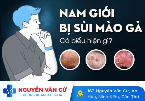 Dấu Hiệu Nhận Biết Bệnh Sùi Mào Gà Ở Nam Giới