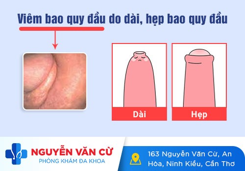 Bộ Phận Sinh Dục Nam Bị Bong Da – Bệnh Lý Nam Khoa Thường Gặp